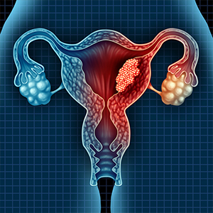 Gynecological Cancers