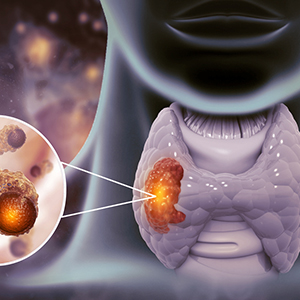 Endocrine Cancers
